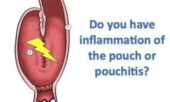 Pouchitis