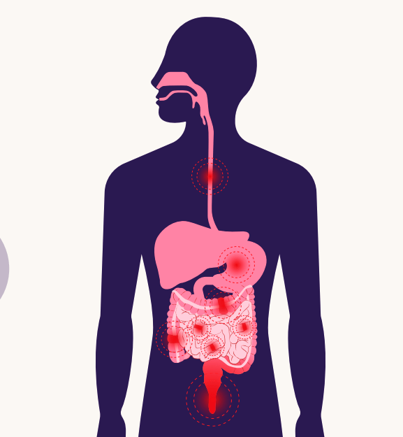 illustration of Crohn's disease