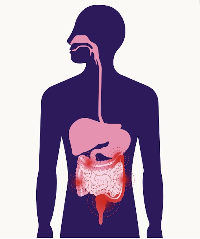 Illustration of ulcerative colitis